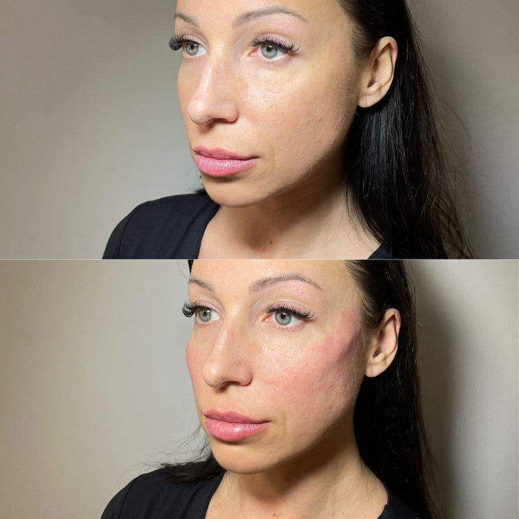 Non-Surgical Gaunt Face and Cheeks Treatment Options in the UK