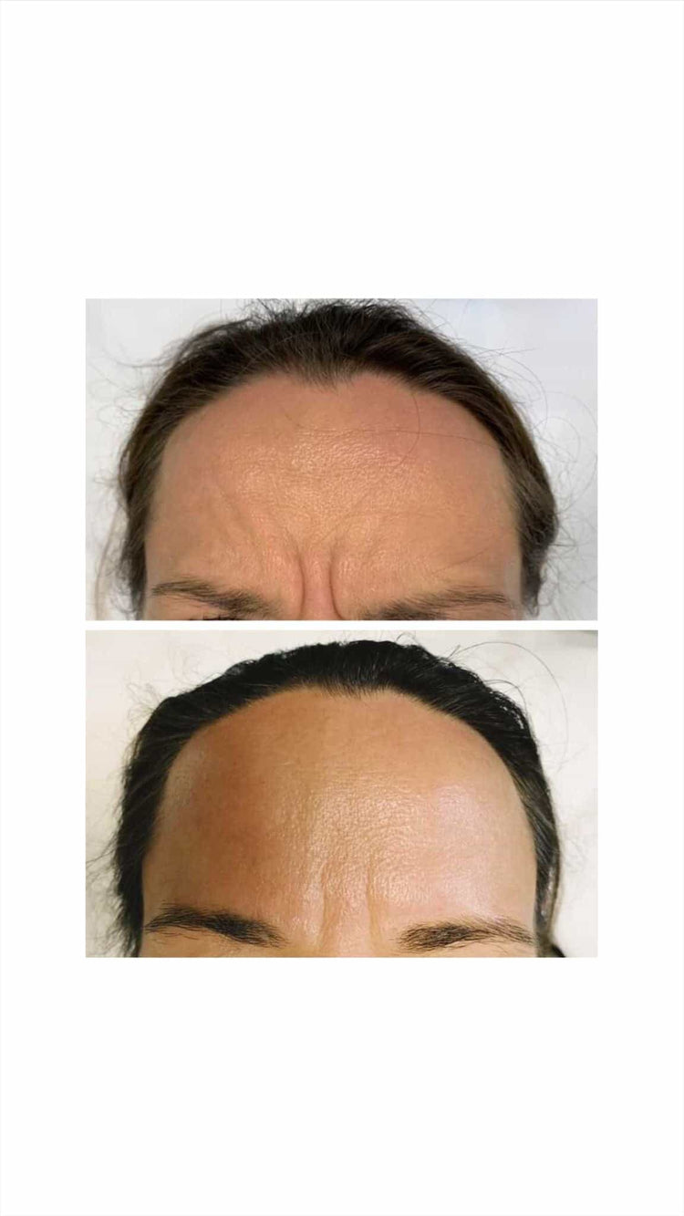 Preauricular Filler in Haslemere, Surrey