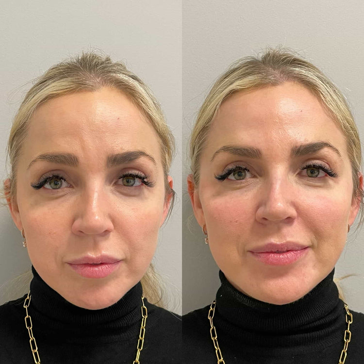 Botox For Tired Eyes in Oxted, Surrey