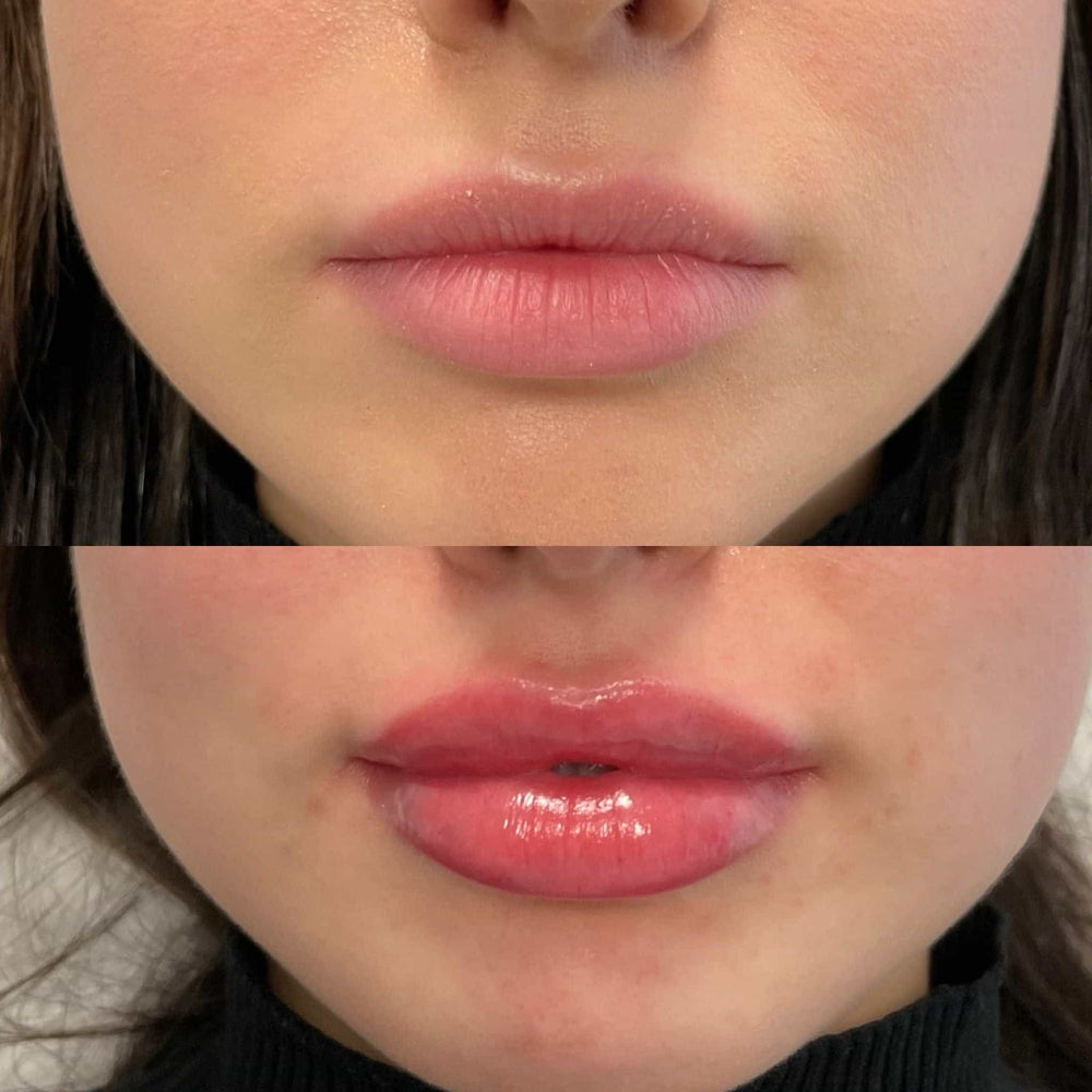 Is Botox or filler better for jawline?