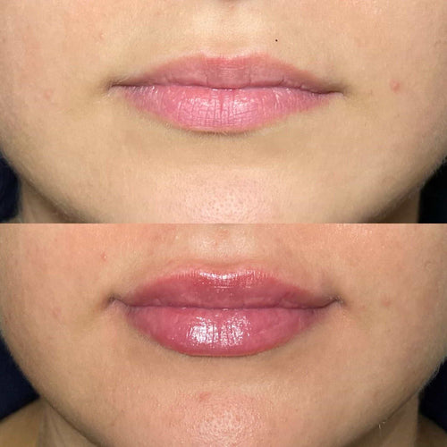 Why do my marionette lines look worse after fillers?