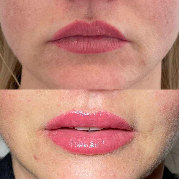 How to Deal with Lip Filler Lumps and Bumps