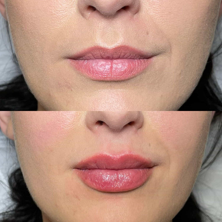 Midface Volume Restoration in Fetcham, Surrey