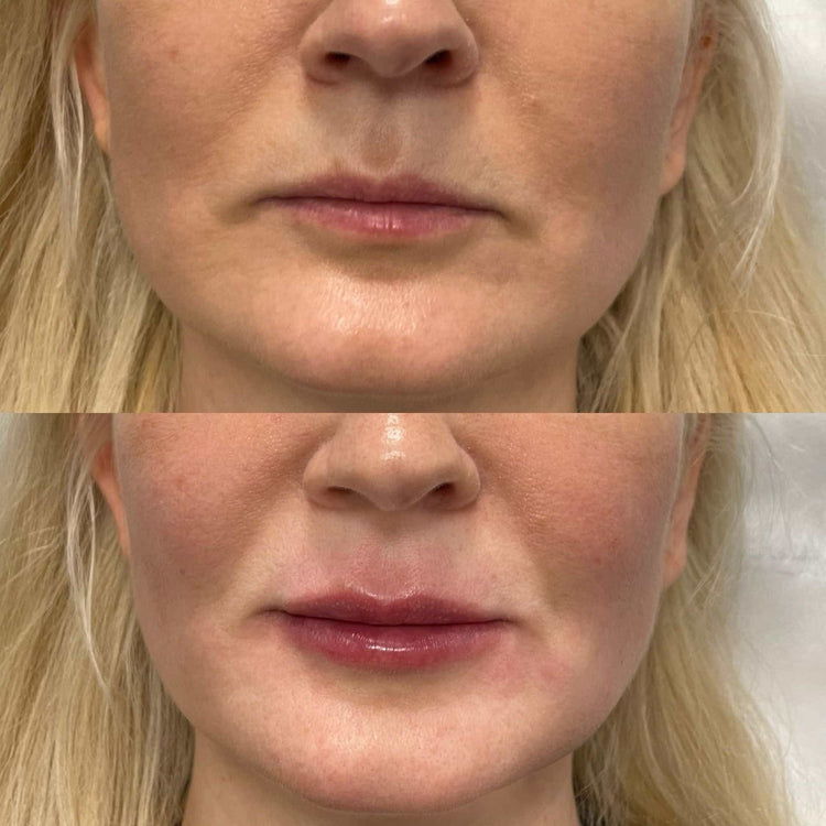 Botox Jaw Slimming (Masseter Reduction) in Barnes, London
