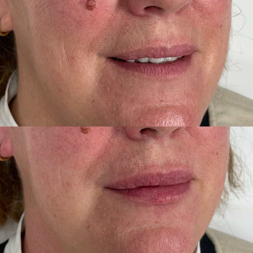 How To Make Lip Filler Last Longer