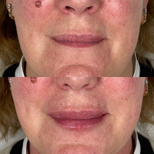 What Is The Best Non Surgical Facelift For 2024?