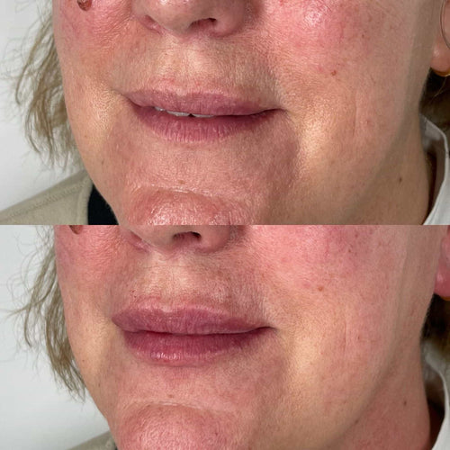 How To Make Lip Filler Last Longer