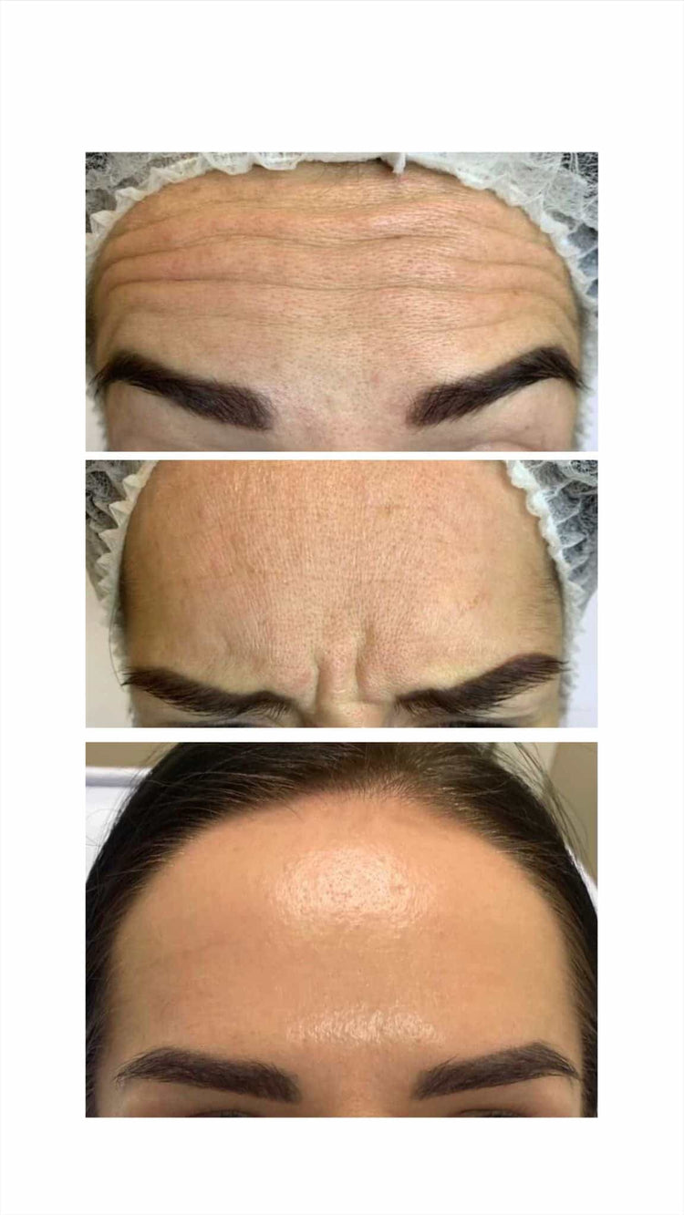 Botox For Dark Circles in Staines-upon-Thames, Surrey