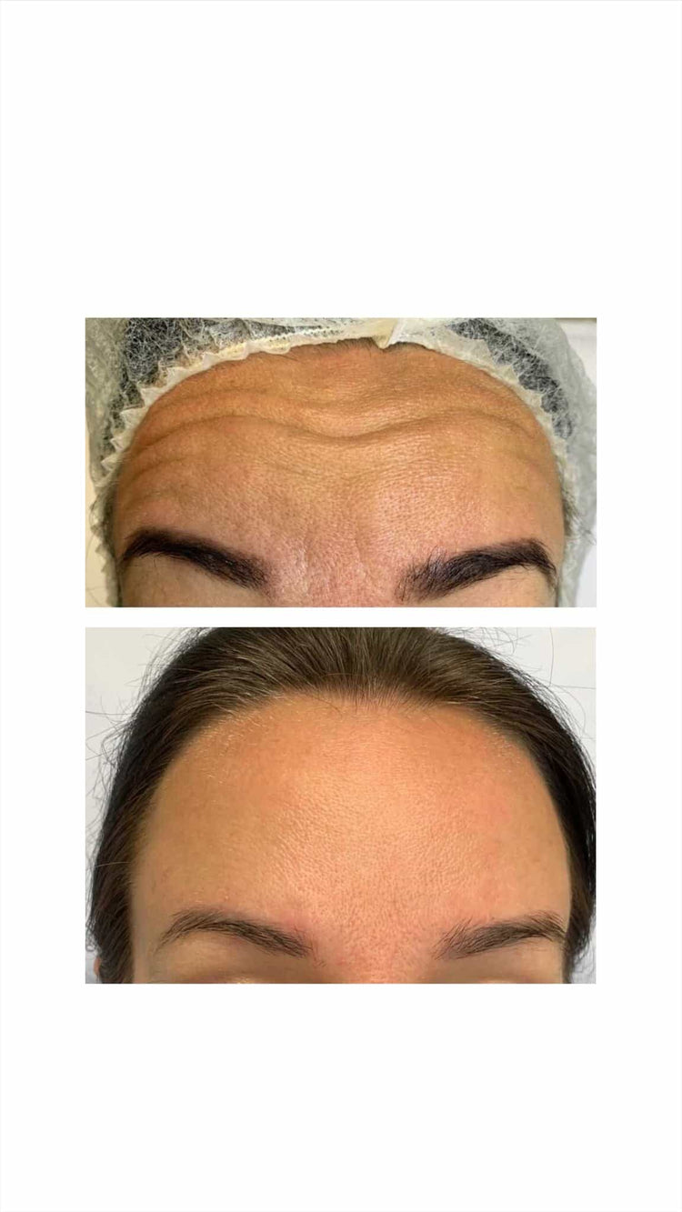 Botox For Dark Circles in Staines-upon-Thames, Surrey