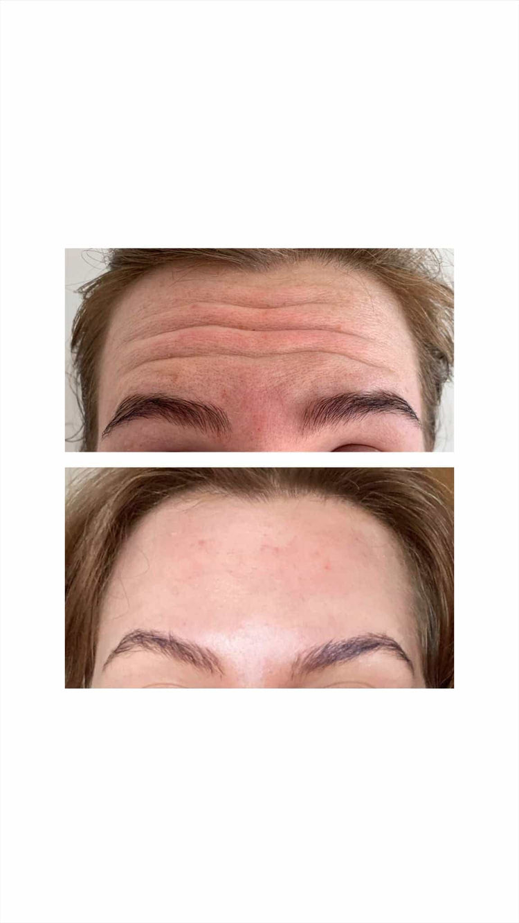 Botox For Dark Circles in Staines-upon-Thames, Surrey