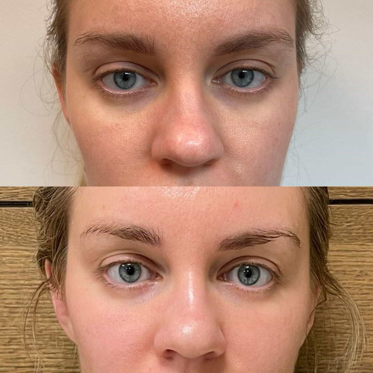 Neauvia Hydro Deluxe in Elstead, Surrey